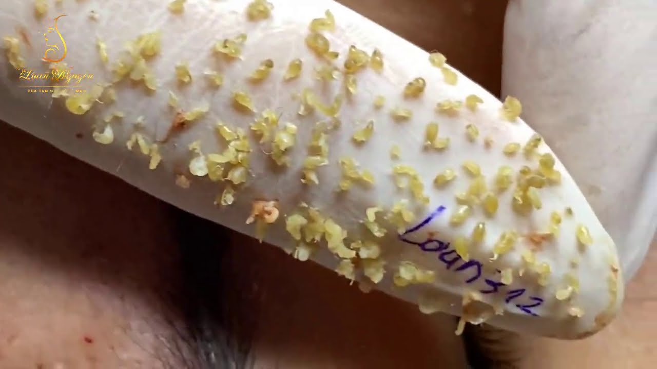 More Ganglion Cysts Busted Pimple Popping Videos