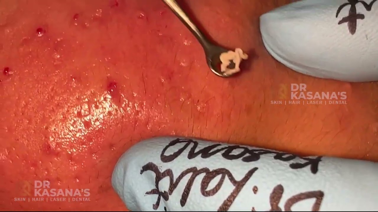 Pilonidal Abscess Emergency Incision Drainage Pimple Popping Videos