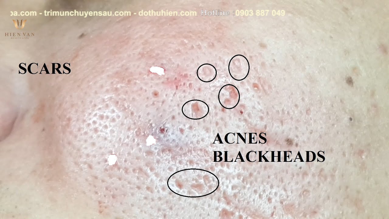 Acne Treatment For "Hung" (P12) | Điều Trị Mụn Cho Hùng (P12