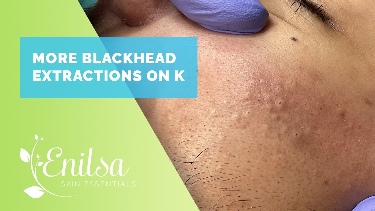 Blackheads Removal By Drlalit Kasana New Video 15 Nov 2022 Pimple