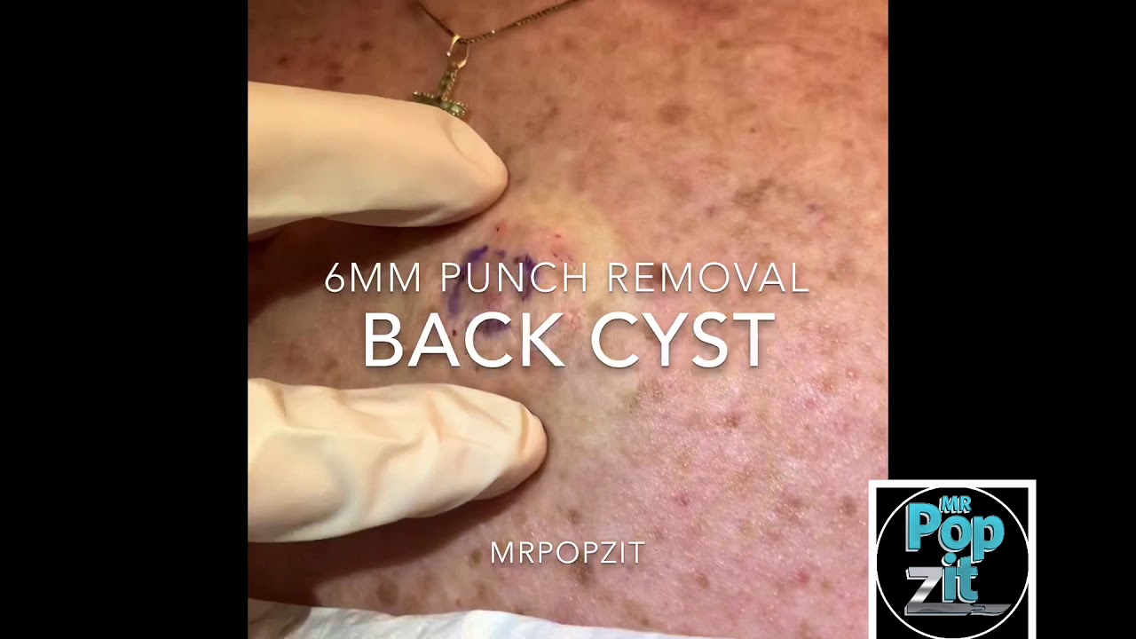 Drainage and punch removal of cyst. Cyst pop. Big squeeze. Punch