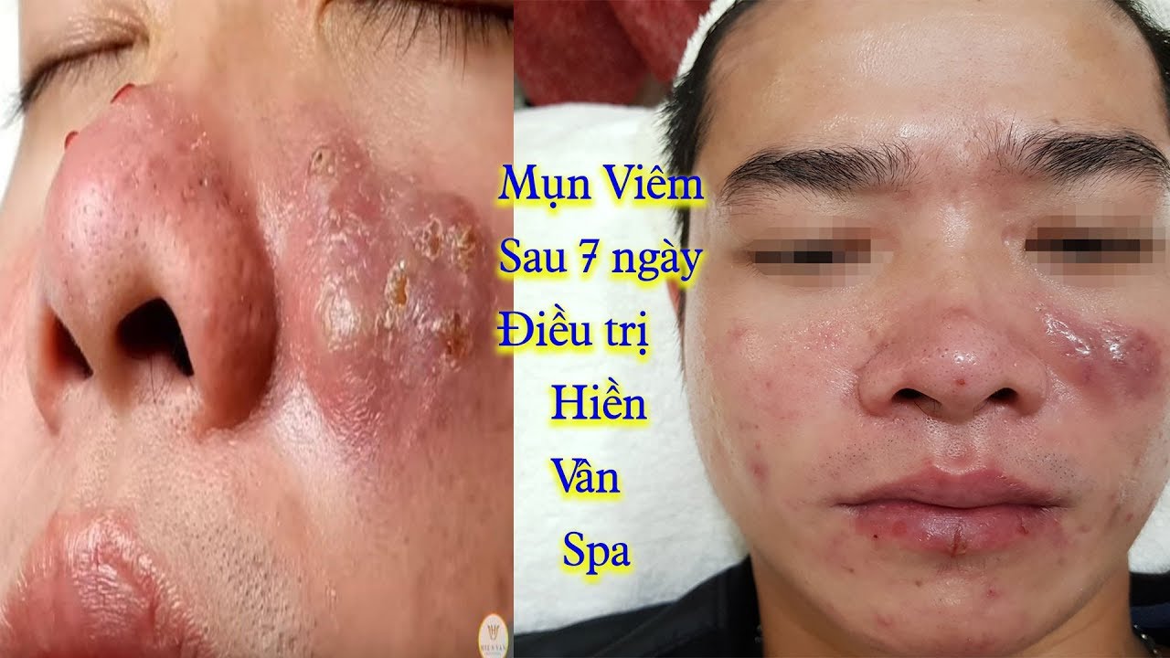How to Get Rid of Blackheads on the face Loan Nguyen Pimple Popping