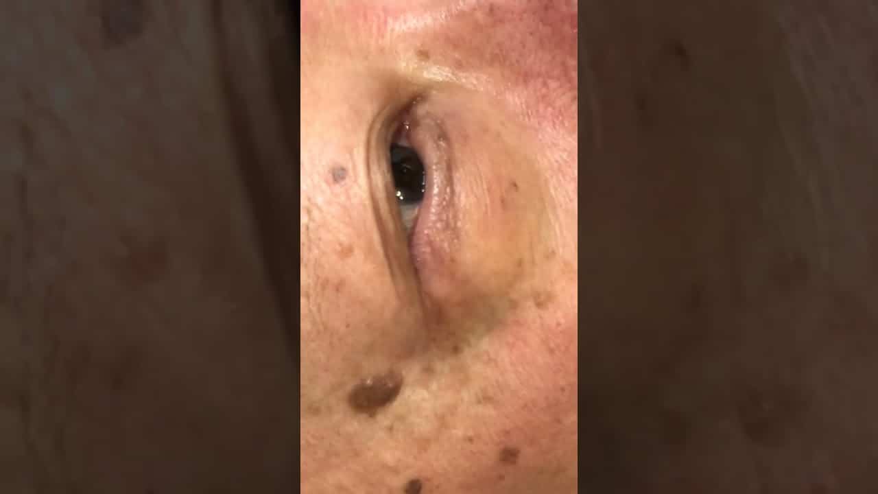 Huge Sebaceous Cysts Removed From Leg Pimple Popping Videos