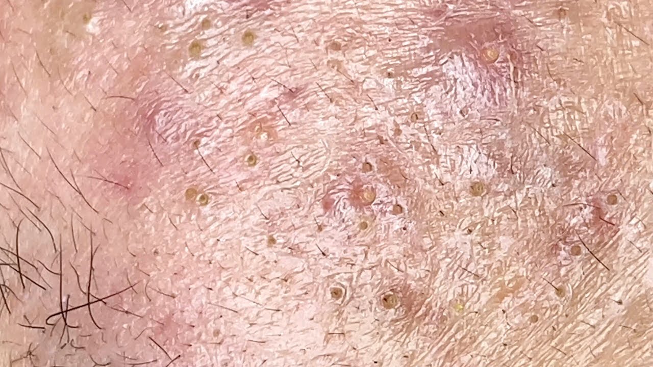 Infected Pilonidal Cyst Popping Puss Pimple Popping Videos