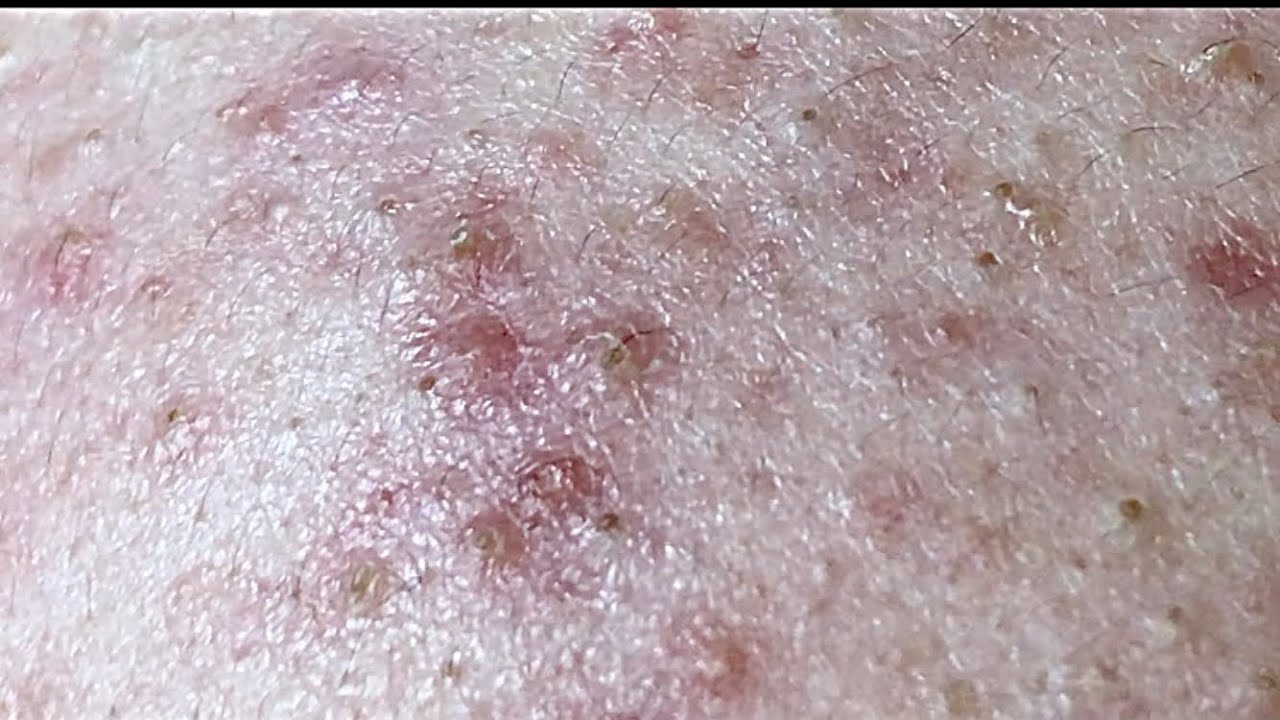 Lancing a huge boil on my leg! - Pimple Popping Videos