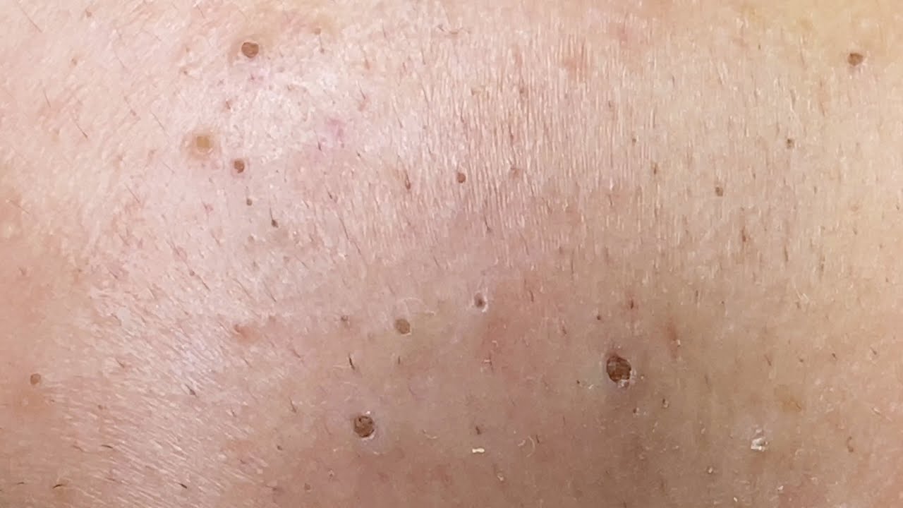 Loan Nguyen Acne Treatment 3787 - Pimple Popping Videos