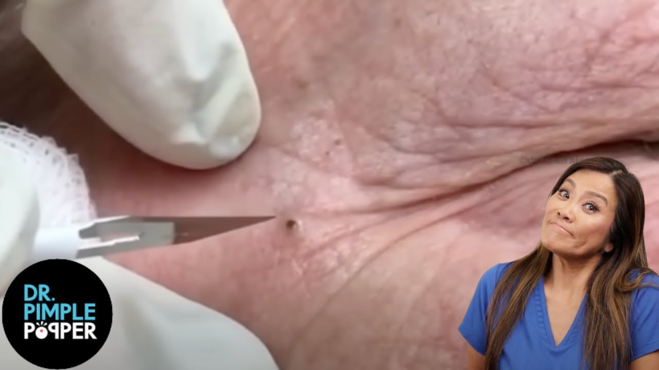 Remove blackheads on forehead and cheeks (175) Loan Nguyen Pimple