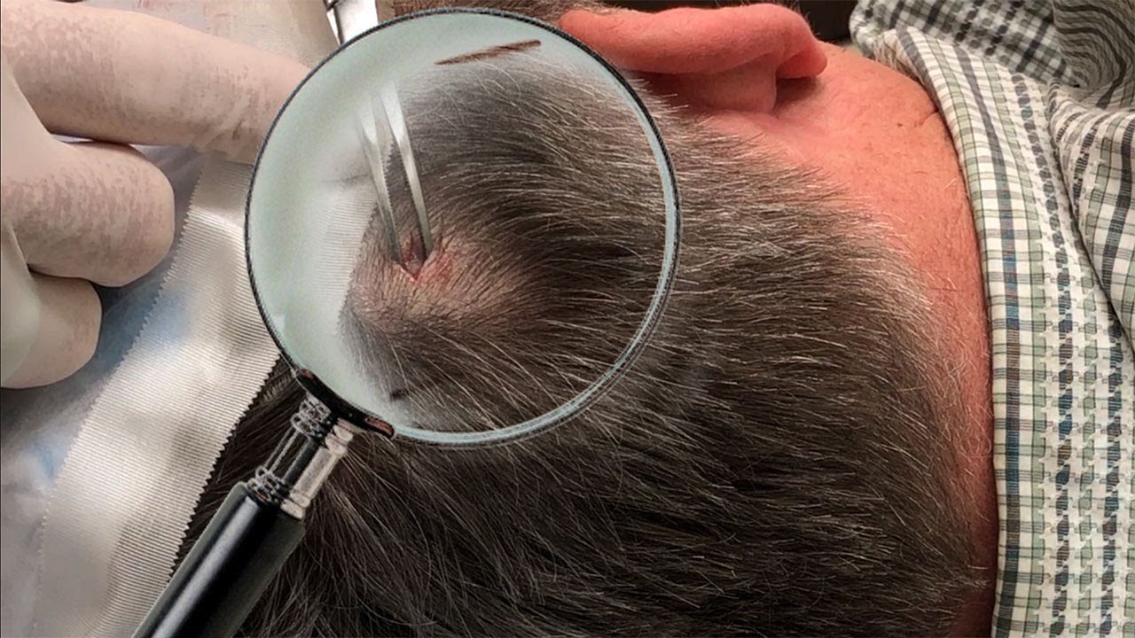 Scalp Cyst Up Close Pimple Popping Videos 