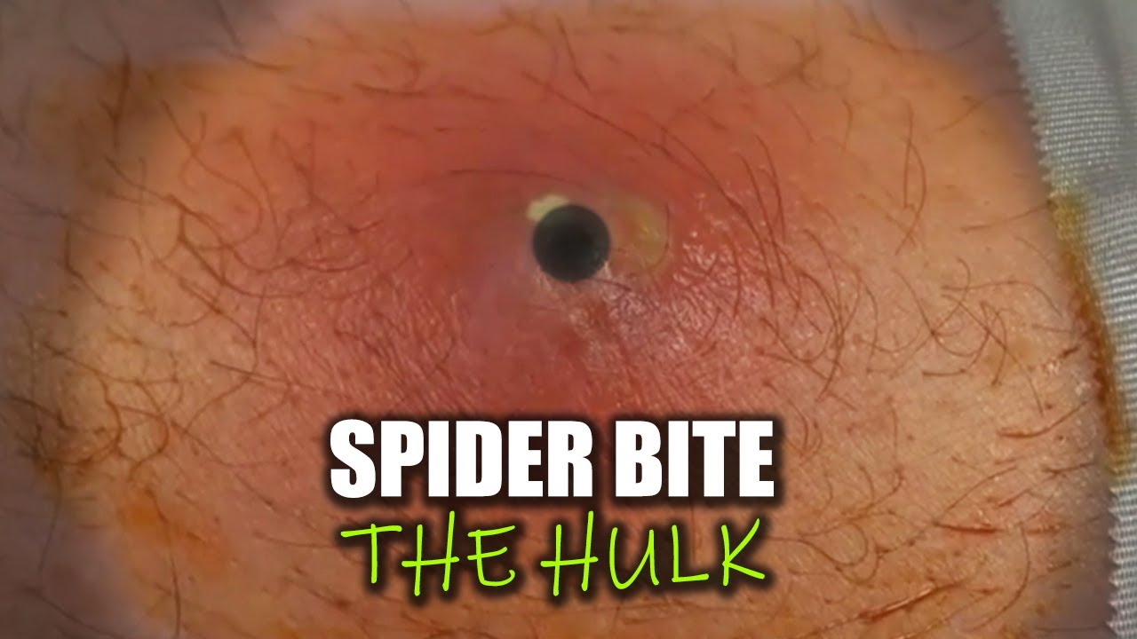 texas-worst-spider-bite-hulk-s-aftermath-3-top-ten-all-time