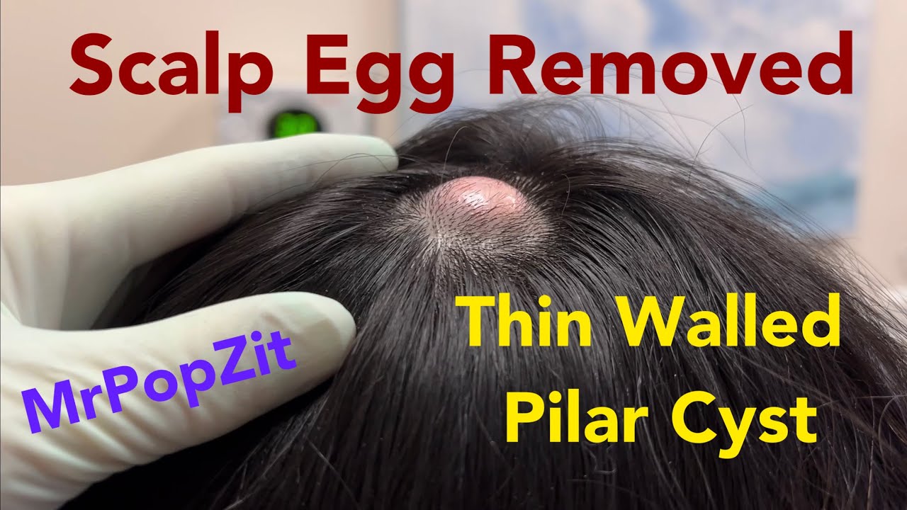 Thin Walled Pressurized Pilar Cyst Removed Pressure Released And Sac