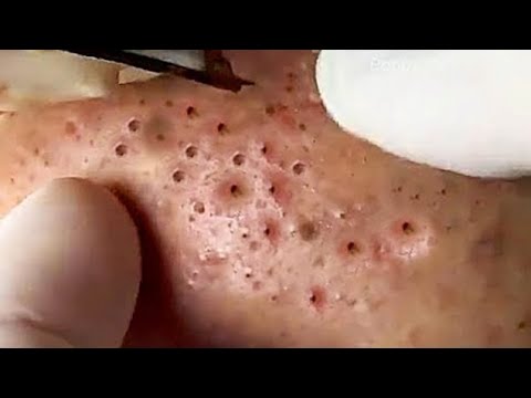 #0007 Big Cystic Acne Blackheads Extraction Whiteheads Removal Pimple Popping – Milia & Blackheads