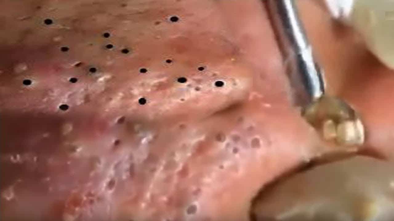 #0008 Big Cystic Acne Blackheads Extraction Whiteheads Removal Pimple Popping – Milia & Blackheads