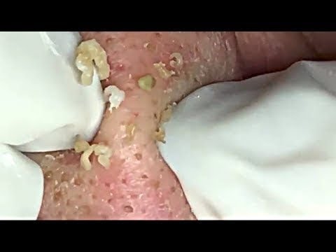 #0009 Big Cystic Acne Blackheads Extraction Whiteheads Removal Pimple Popping – Milia & Blackheads