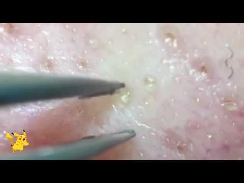01 Blackhead and Whitehead Removal, Acne and Pimple Popping, Cyst Extraction, Zit Squeezing Part 1