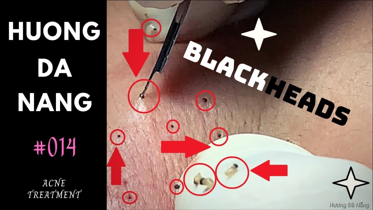 #014 | Lots of surprising BLACKHEADS | Hương Đà Nẵng | akne Behandlung