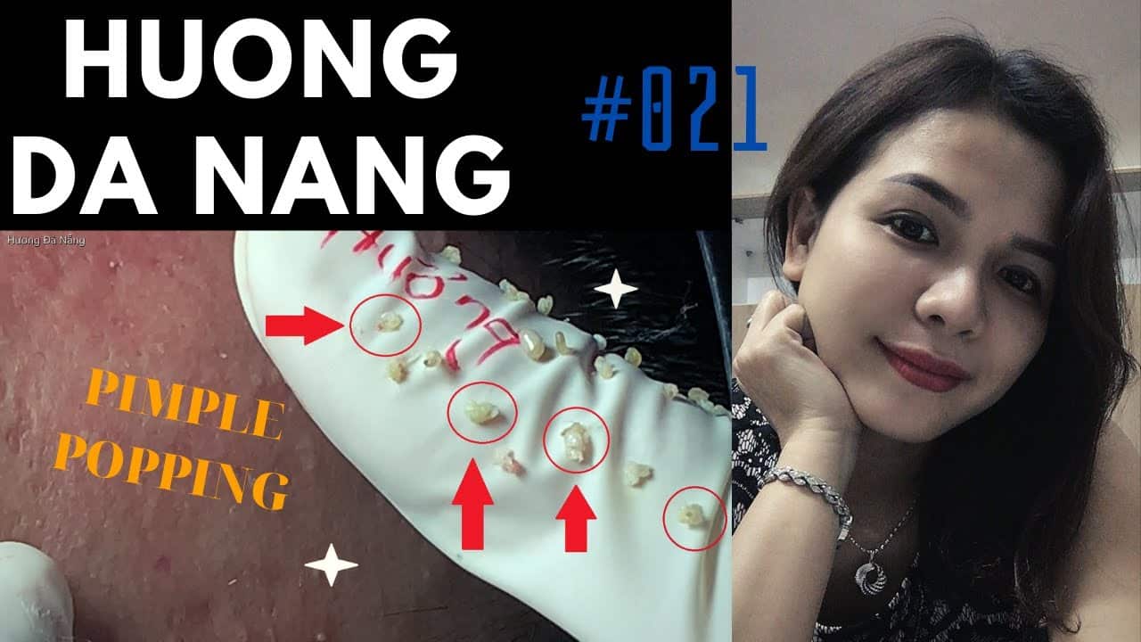 #021 | PIMPLE POPPING | Nặn mụn | Hương Đà Nẵng | akne Behandlung