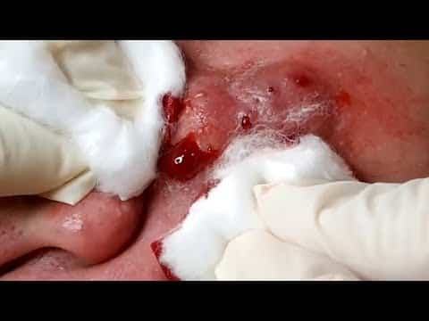 #03 Large Acne Blackhead Cyst Popping