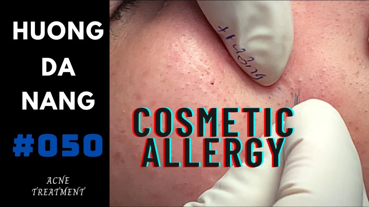 #050 | Hidden acne due to cosmetic allergy | before the demand for Social distancing in Da Nang