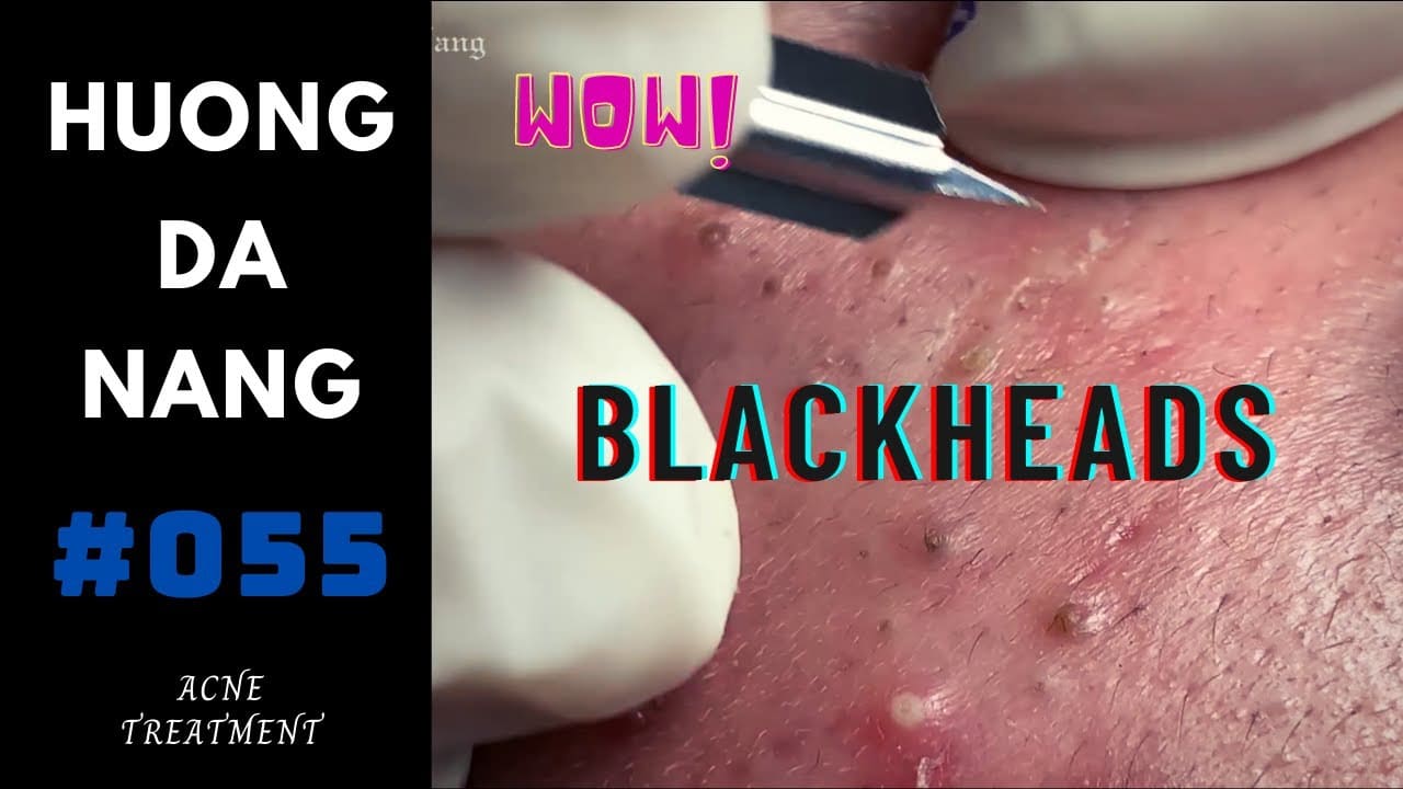 #055 | the fastidious guy's blackheads | Being recorded before Social distancing