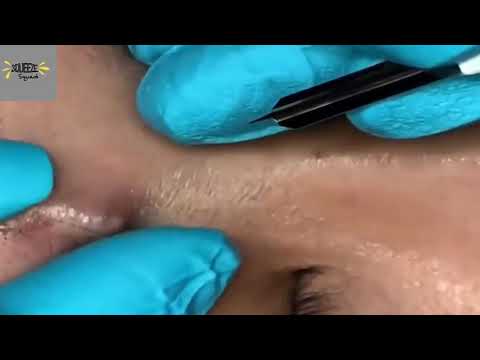 #06 Large Acne Cyst Popping
