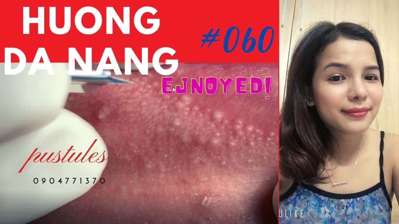 #060 |pustules around the lips and face | Hương Đà Nẵng