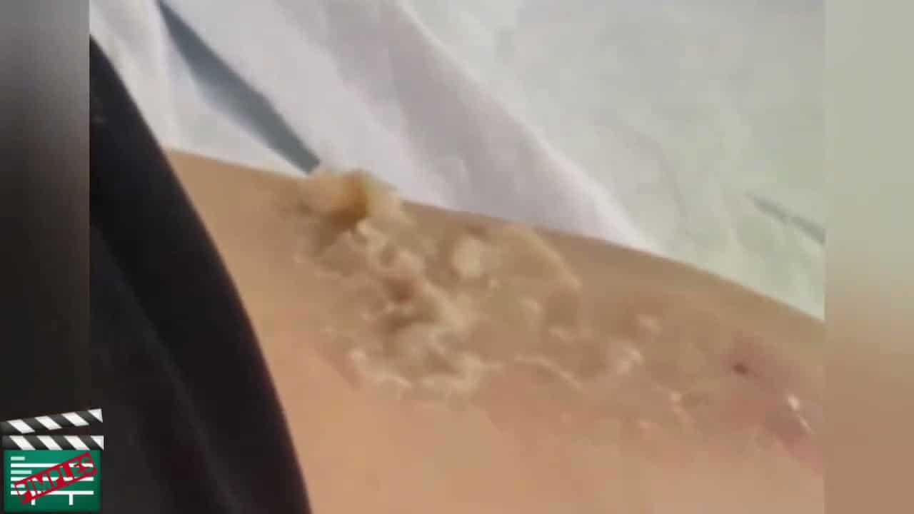 08 Pimple Popping  very satisfying cyst popping