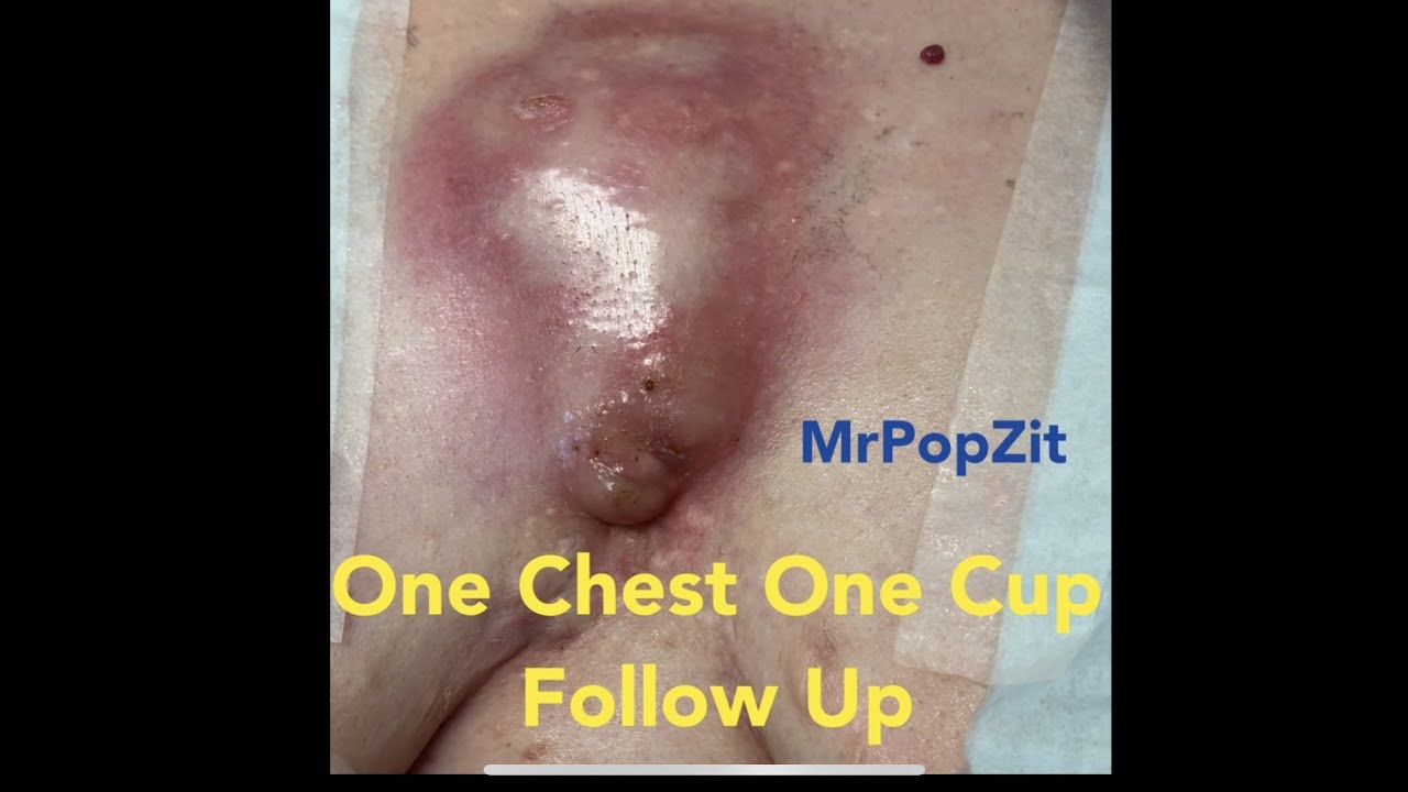 1 chest 1 cup FOLLOW UP! One year post large abscess on chest drainage. Patient doing great!