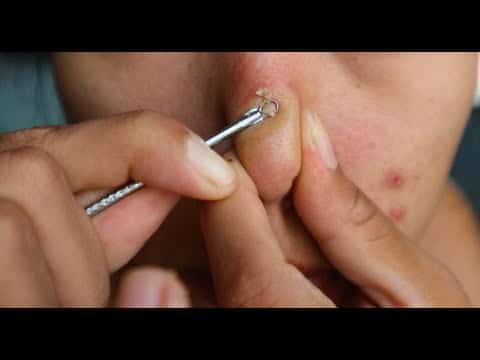 1- pimple popping compilation most popular Sebaceous Cyst Amazing Abscess On Nose of Poor little