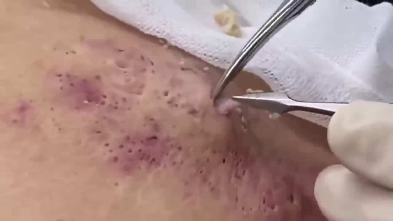 #10 Blackheads on Arm Large Cyst Popping Acne