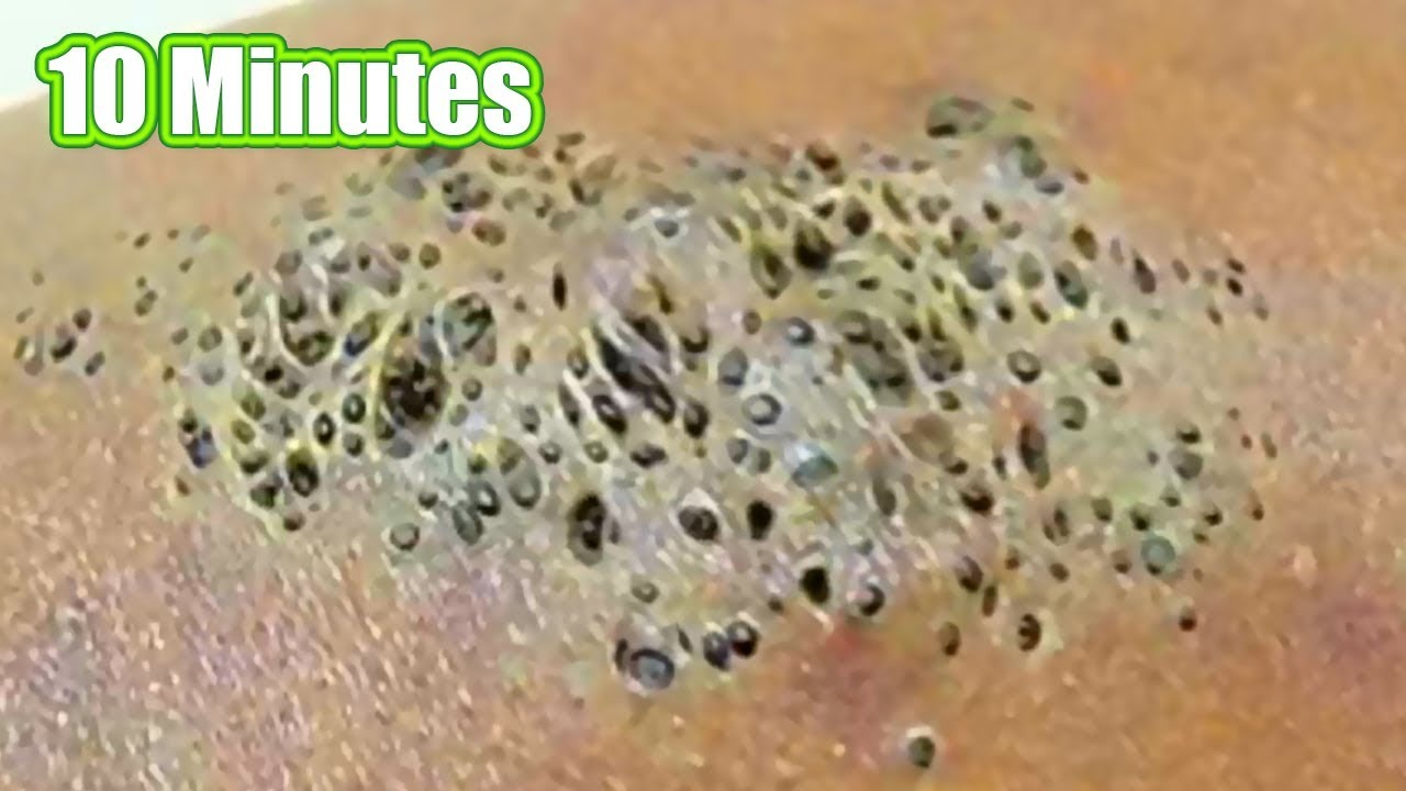 10 Minutes of Pimple Popping, Blackhead Extractions & Whiteheads!  Month in Review