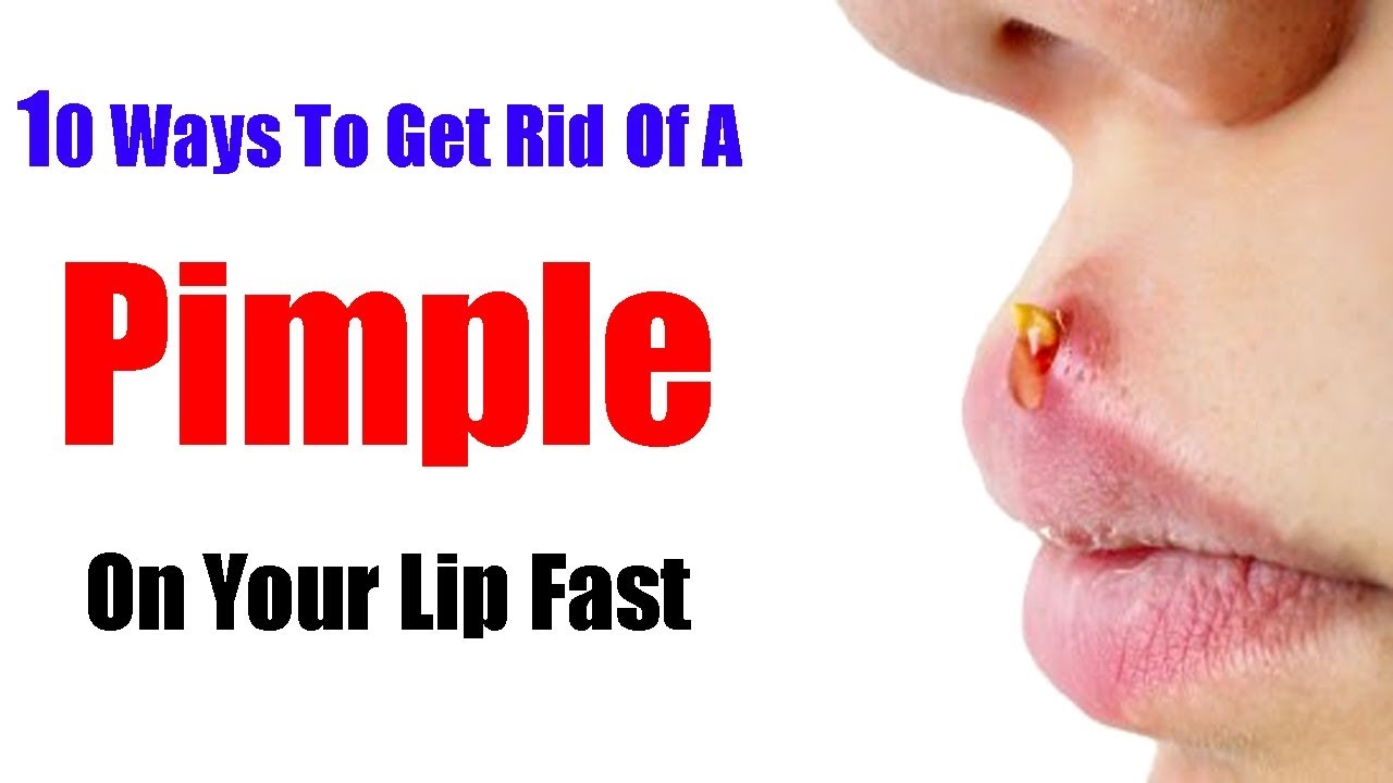 10 Ways To Get Rid Of A Pimple On Your Lip Fast