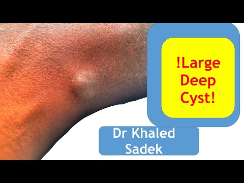 10 year old neck cyst removed. Dr Khaled Sadek. London Cyst Clinic