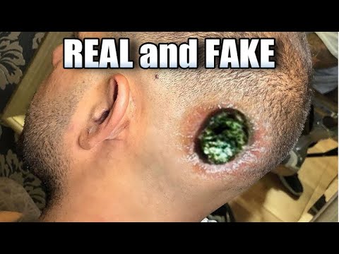1,000 Pimple Pops, Real and Fake!  Best Pimple Popping (Photoshop Pimples)
