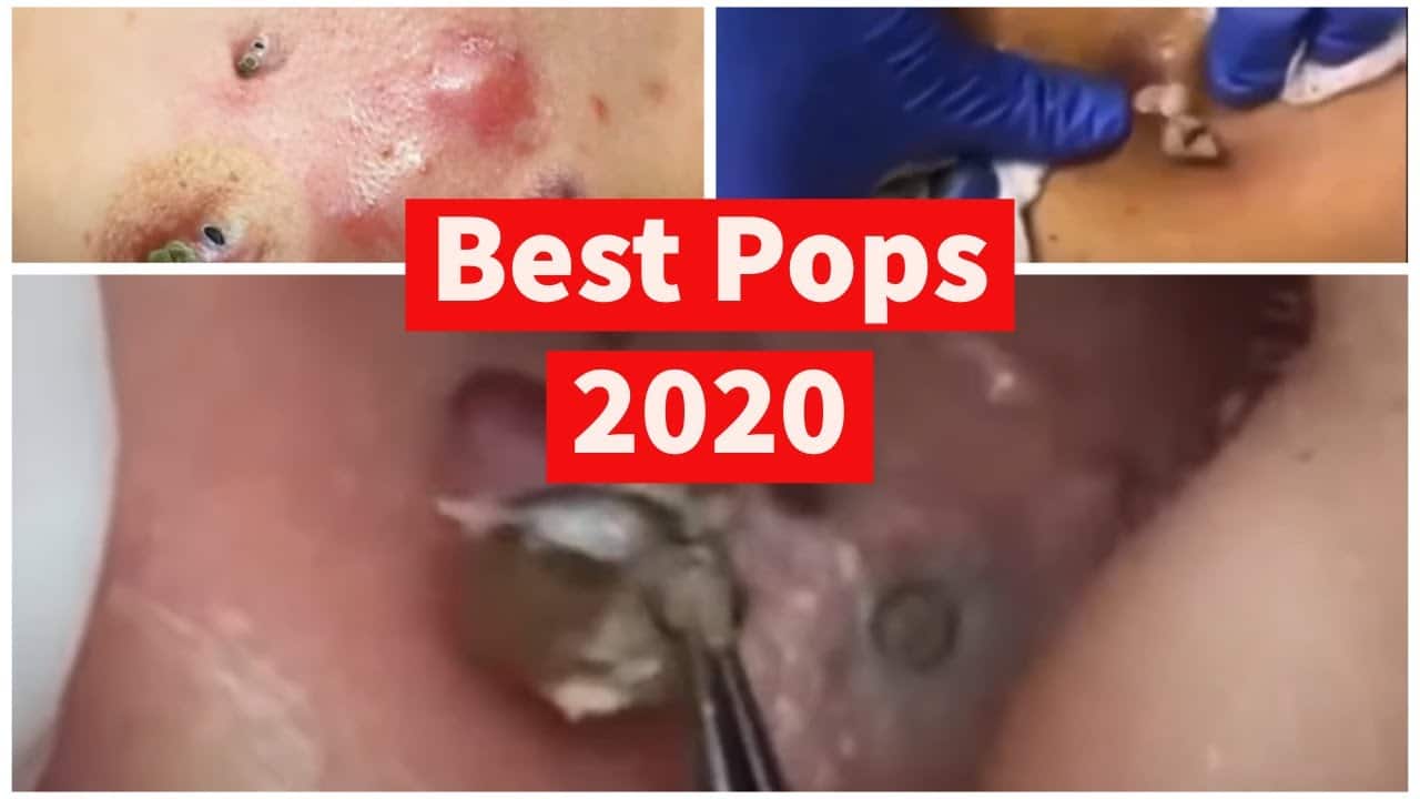 12 Best Pimples, Cysts, and Blackheads of 2020