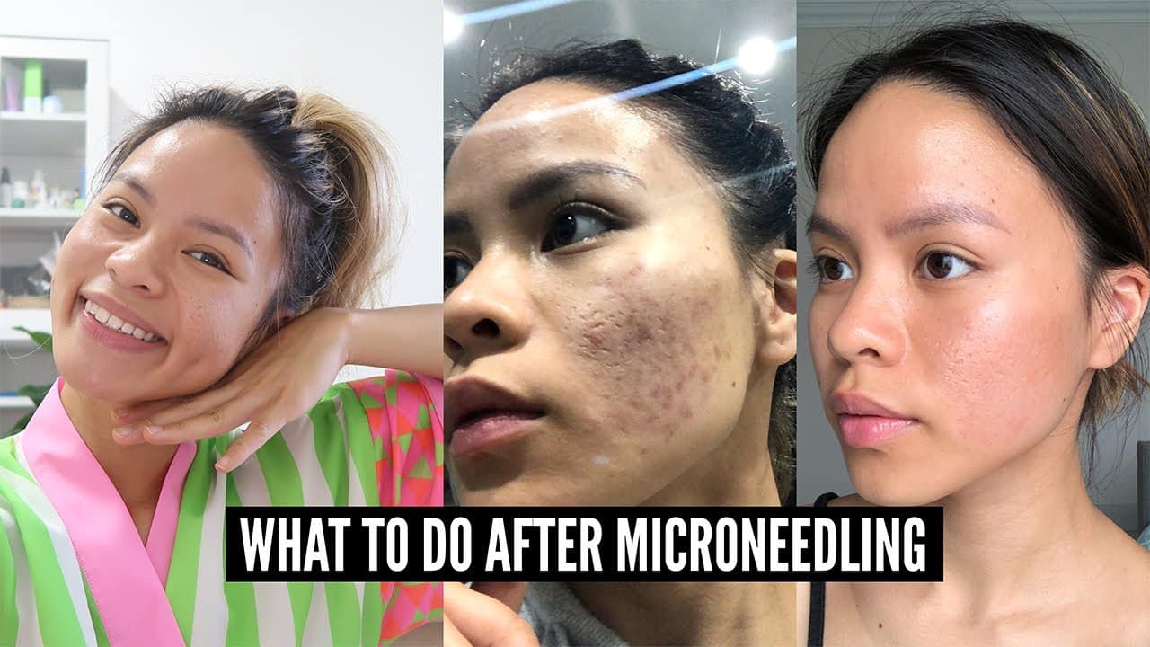 12 Important Microneedling Aftercare Tips