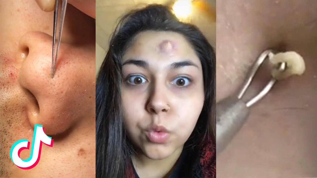 12 Minutes Of Pimple Popping TikTok Compilation