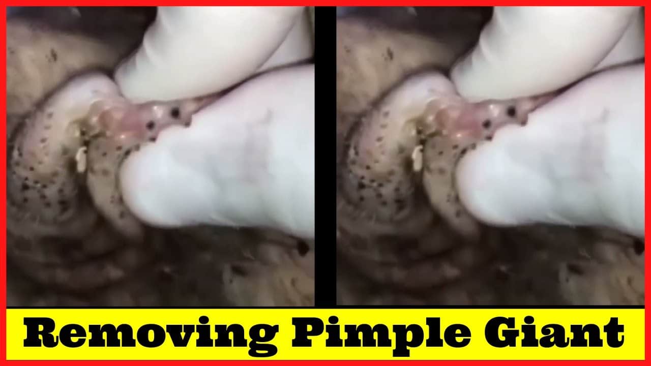12 – Pimple Popping Compilation Most Popular Sebaceous Cyst Amazing Abscess On Nose of Poor little
