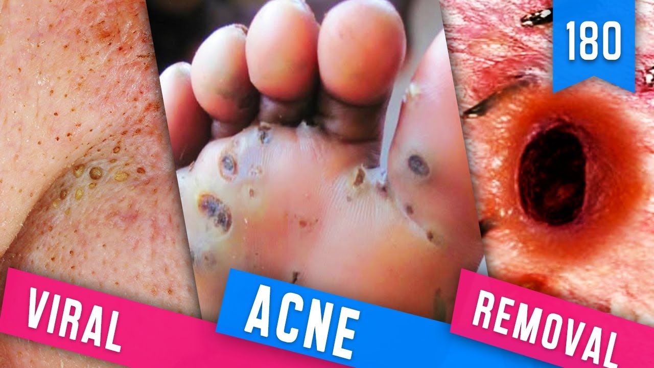 15 VIRAL ACNE REMOVAL  / PIMPLE POPPING