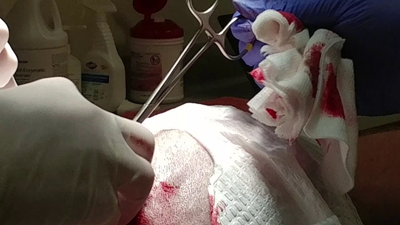 15 + year old cyst removed