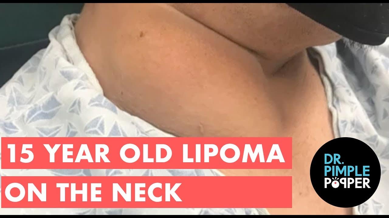 15 Year Old Lipoma on the Neck