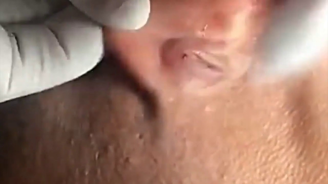 #16 Top 1 Popping Cyst hidden behind ear Popping Cyst treatment