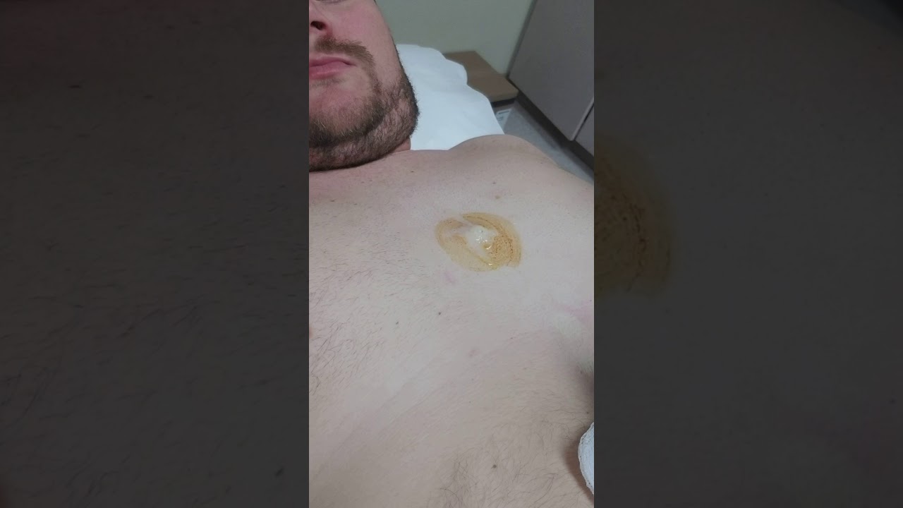 17 year old Cyst finally popped. Woot!