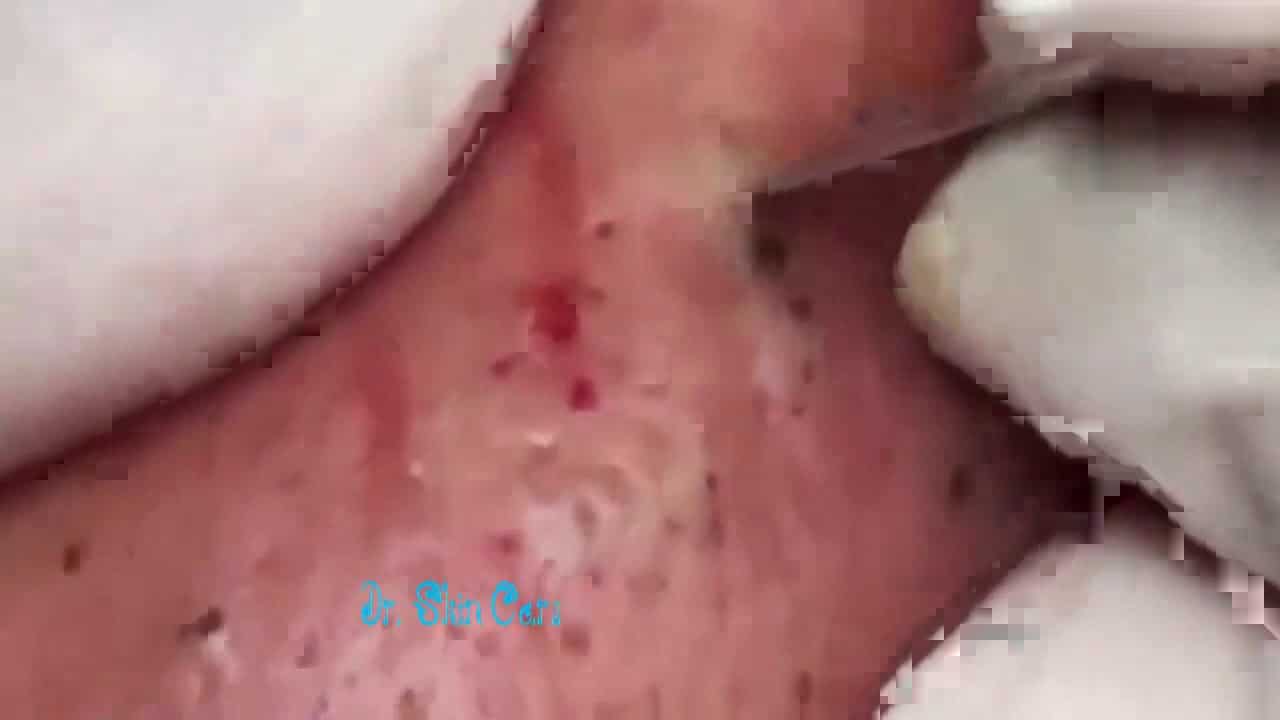 2- pimple popping compilation most popular Sebaceous Cyst Amazing Abscess On Nose of Poor little