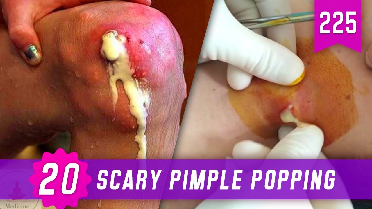 20 SCARY PIMPLE POPPING | PIMPLE FURUNCLES | REMOVE BLACKHEADS | POPPING