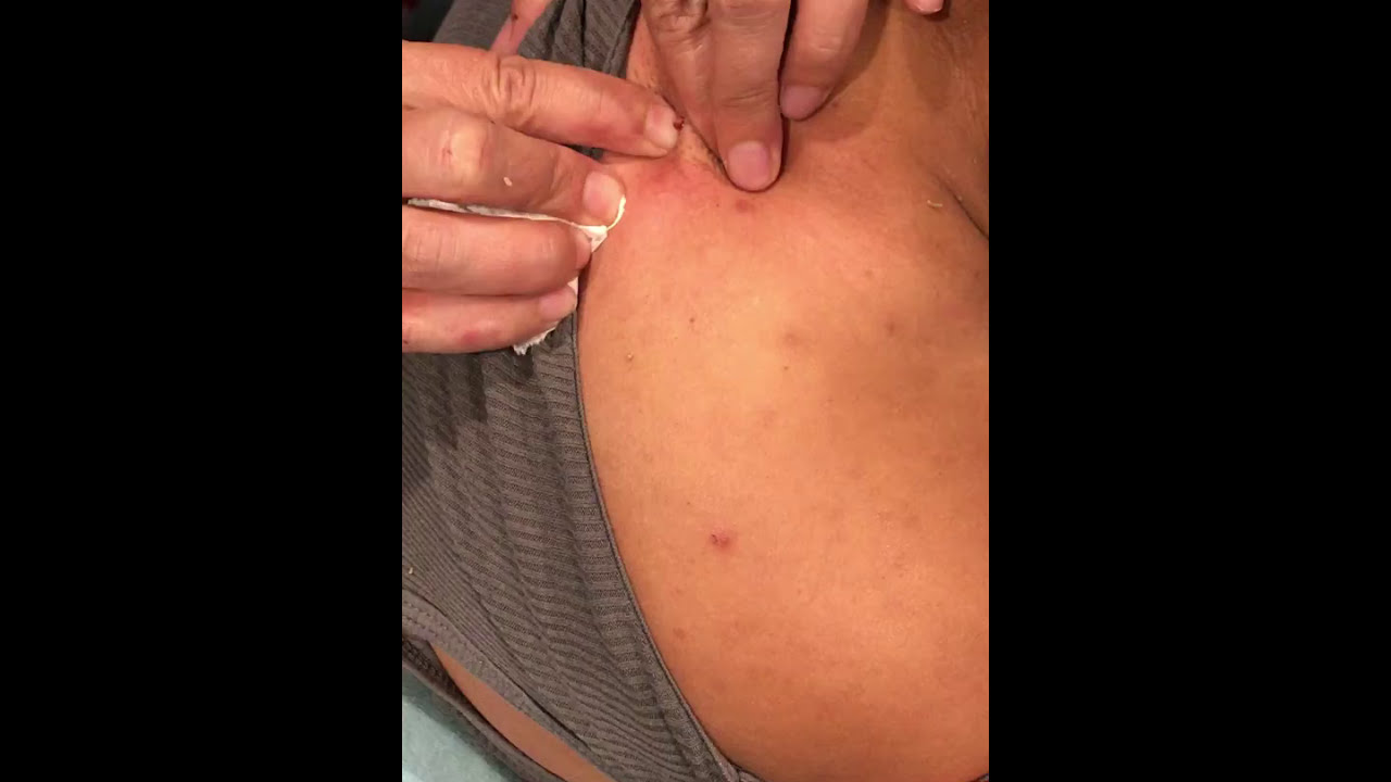 20 year old pimple(cyst)