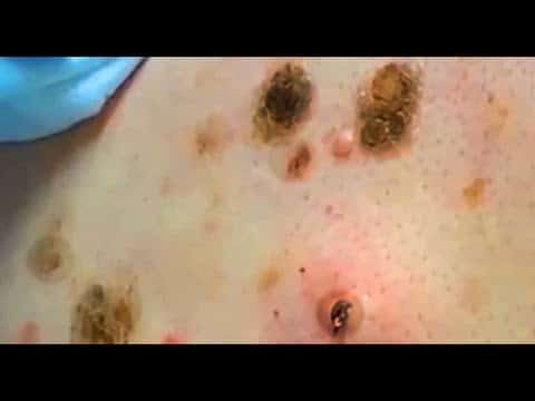 2001 Comedones & Pimple Pops!  Blackheads, Whiteheads and Comedones