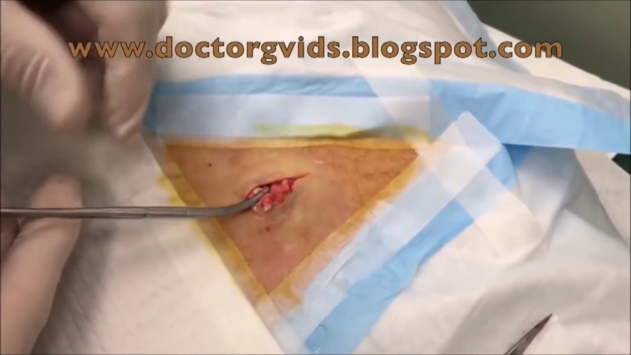 2016 Cyst of the Year!  Popping Awards