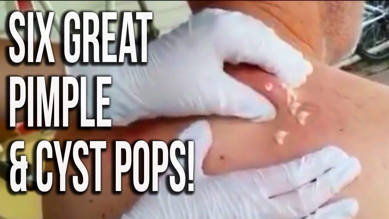 2017’s Best Pimple Pops!  Why Wear Gloves? ????