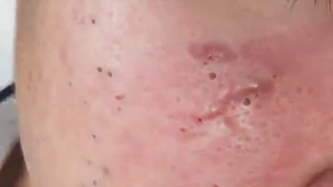 2019 MOST SATISFYING PIMPLE popping ever!!!