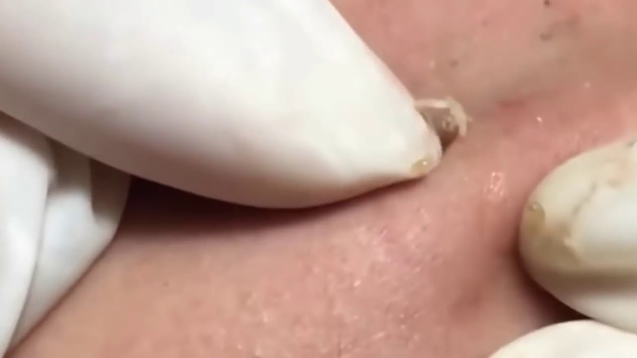 2019 Satisfying Pimple, Black Head & Cyst popping Compilation